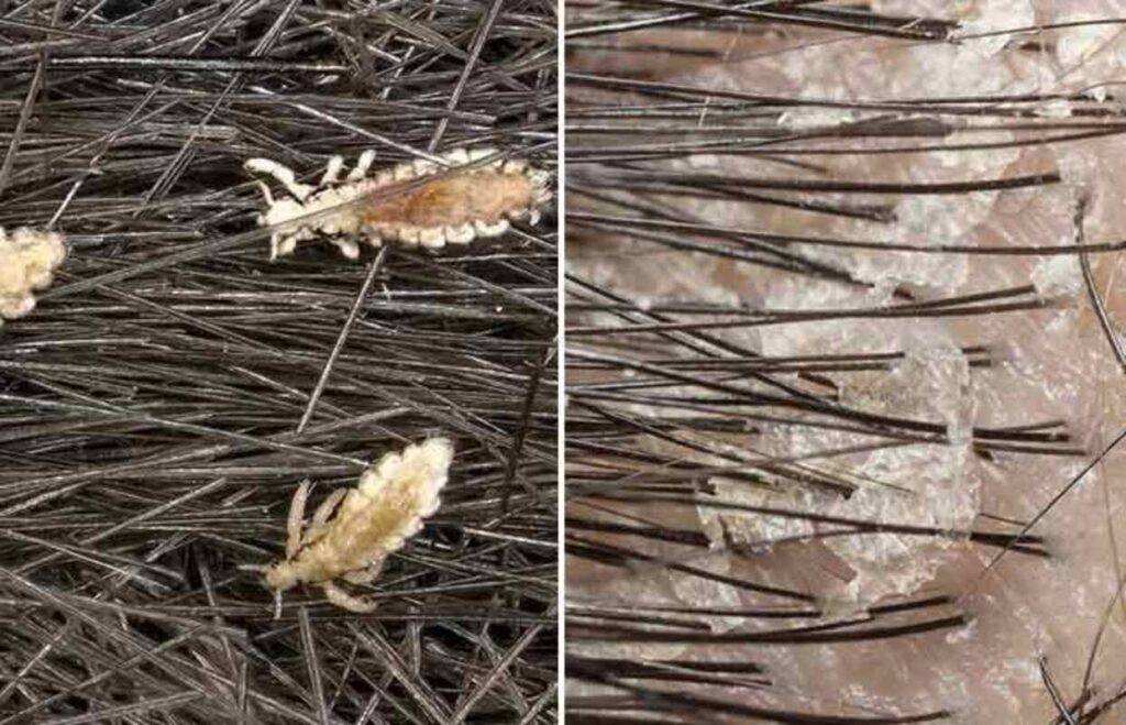 Zoomed in picture of lice and dandruff in unkempt hair