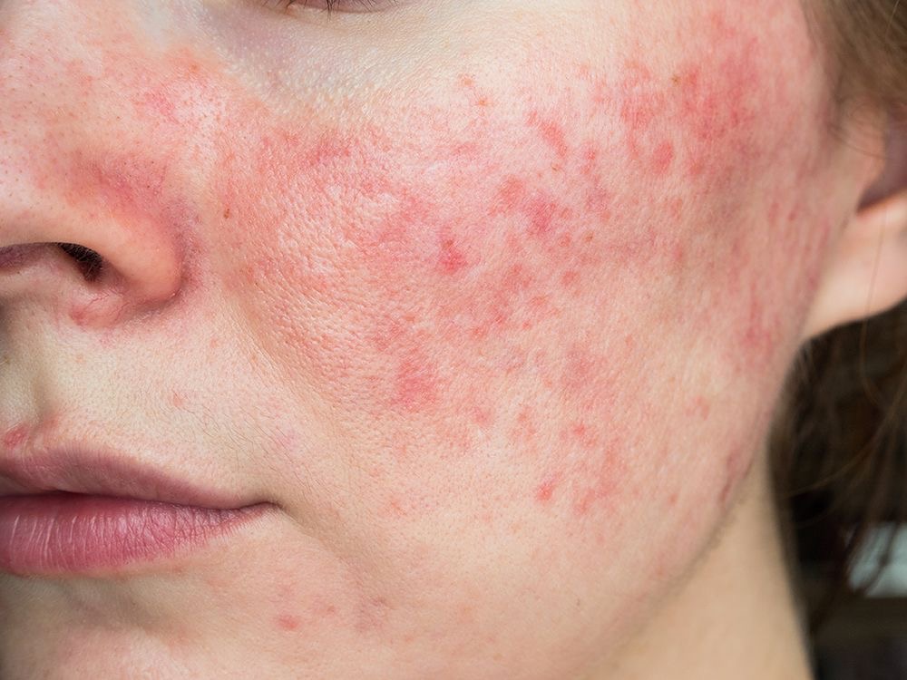 A woman with rosacea