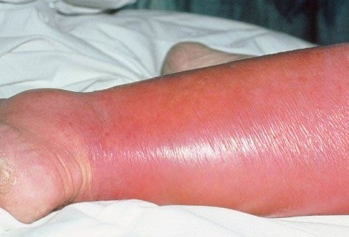 Cellulitis