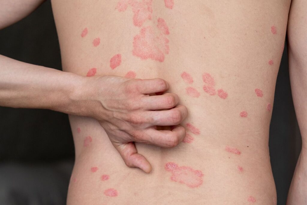 Psoriasis on a person’s back