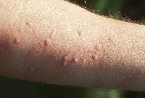 a bed bug reaction/allergy